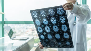 How Malone Law Medical Malpractice and Severe Injury Lawyers Can Help With a Brain Damage Claim in Atlanta, GA