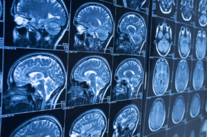 Why You Should Call Malone Law Medical Malpractice and Severe Injury Lawyers for Legal Assistance After a Brain Injury in South Fulton