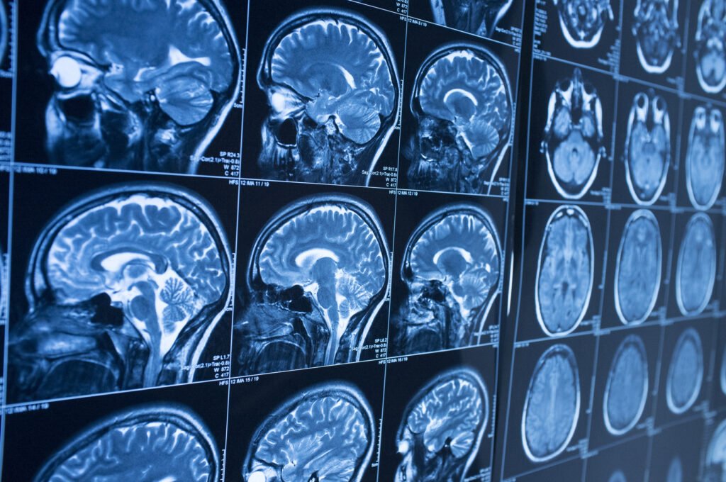 Symptoms of a Brain Bleed to Look for After a Head Injury