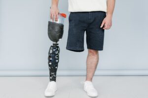 Common Causes of Amputation Injuries in Atlanta, GA